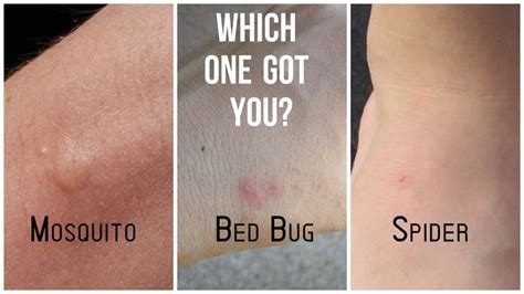 What S The Difference Between Bed Bug Mosquito And Spider Bites Bed Bug Bites Bug Bite