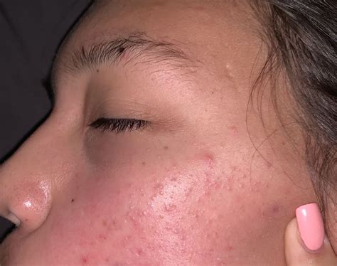 Small Light Textured Bumps Help Other Acne Treatments