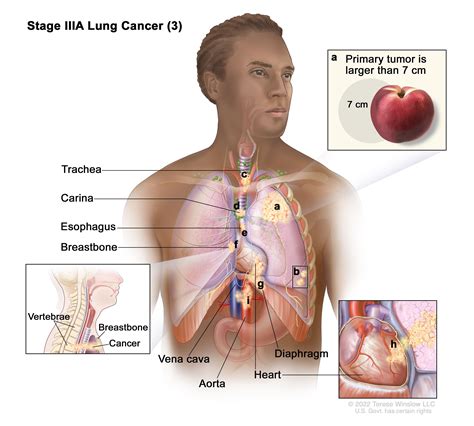 Non Small Cell Lung Cancer Treatment PDQ NCI