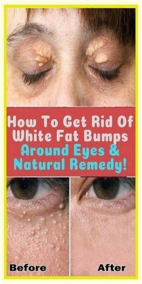 How To Get Rid Of White Fat Bumps Around Eyes Naturally