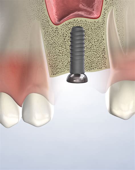 Bone Grafting In Silverdale Poulsbo And Port Orchard Wa Kitsap Oral