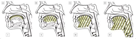 Microcystic Lymphatic Malformations Of The Tongue Diagnosis