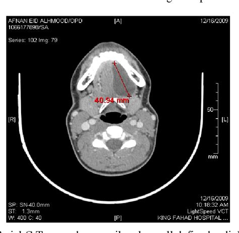 Figure 5 From Unilateral Dermoid Cyst Of The Floor Of The Mouth