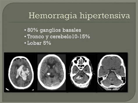 Hemorragia cerebral parenquimatosa no traumática posibles causas y su