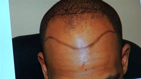 Use your hands instead of a brush when hair is dry. Black Bald Hair Transplant FUE Result Black Man Receding Line 1 yr Follow Up www.mhtaclinic.com ...