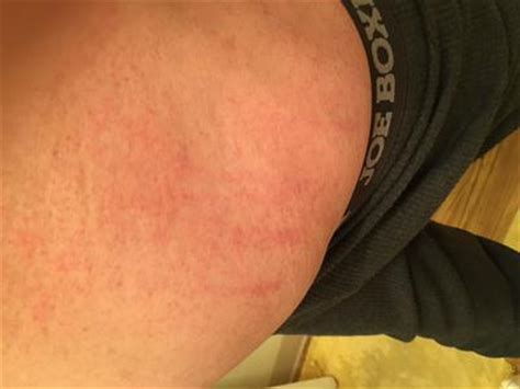 Did you scroll all this way to get facts about heal rash scratches ? Red Scratch Like Dotted Rash