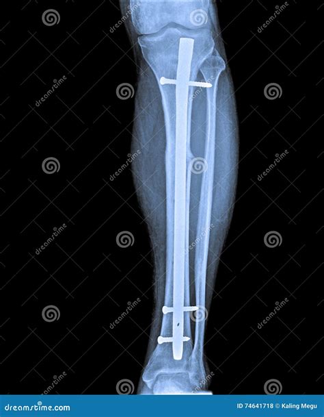 X Ray Of Leg With Fracture And Implant Stock Photo Image Of Diagnosis