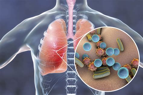 Bacterial Pneumonia In People With Copd