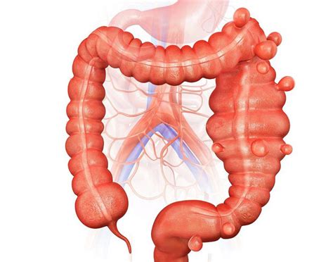 Diverticulose De Colon Esquerdo