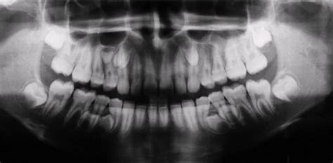 Radiografia De Los Dientes