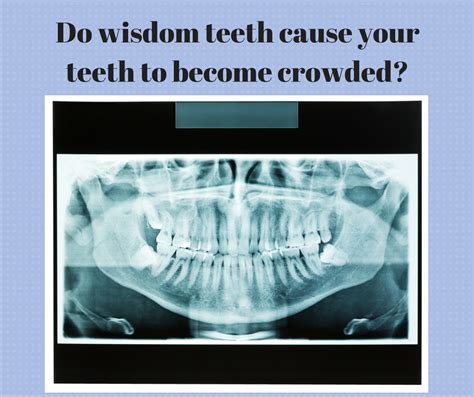 Do Wisdom Teeth Cause Your Teeth To Become Crowded — Mashouf Orthodontics