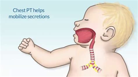 Chest Physiotherapy By Susan Hamilton Ms Rn For Openpediatrics