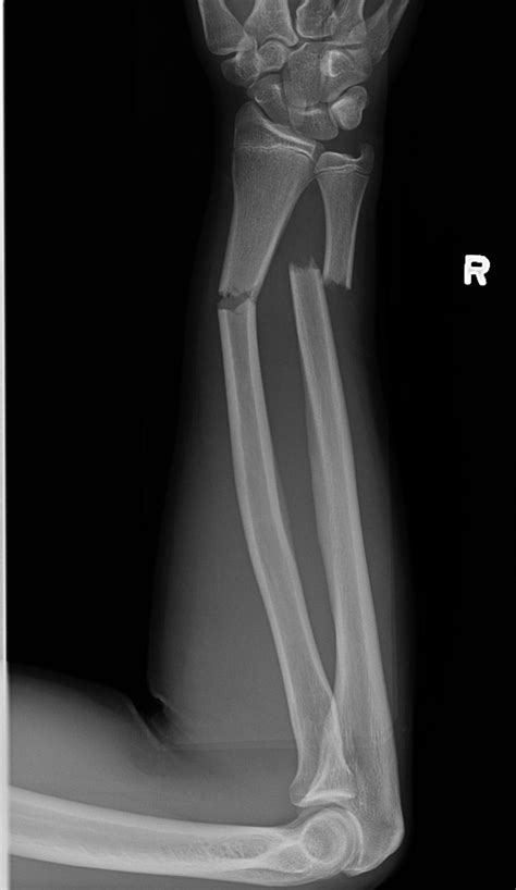 Both Bone Forearm Fracture Pediatric Pediatrics Orthobullets