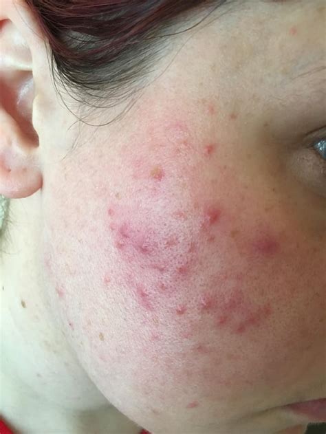 Skin Concerns Moved Country And Suddenly Right Cheek Acne Rskincareaddiction