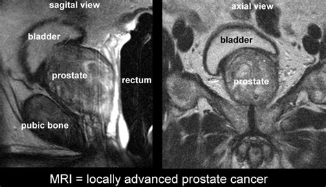 Prostate Anatomy Mri