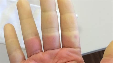 Everything You Need To Know About Raynauds Disease