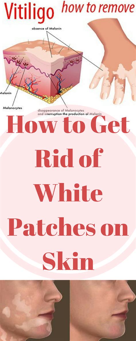 How To Get Rid Of White Patches On Skin Fitness Fiesta