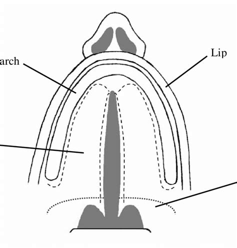 Schematic Drawing Of A Cleft In Both The Hard And The Soft Palate