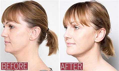 Thread Lift Before And After Jowls Things To Do Before And After A