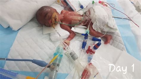 Singapores Smallest Premature Baby Weighing 345g Beats The Odds To
