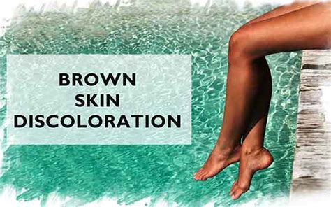 Brown Skin Discoloration On Lower Legs Ankles Face And Neck Wellness