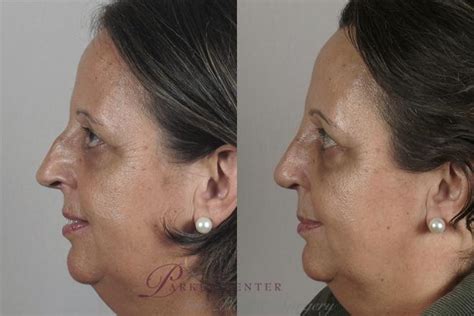 Rhinoplasty Before And After Pictures Case 153 Paramus Nj Parker