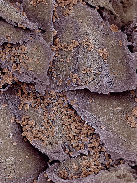 Infected Nail Sem Photograph By Steve Gschmeissner Fine Art America