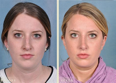 Reconstructive Rhinoplasty Before And After Colorado Plastic Surgery