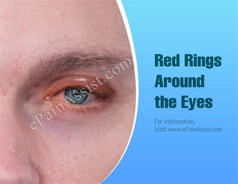 Red Rings Around The Eyes Causes And Treatments