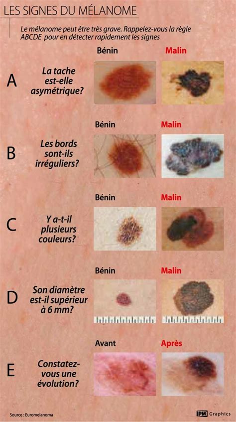 Quel Est Létat De La Recherche Sur Le Mélanome Santecool