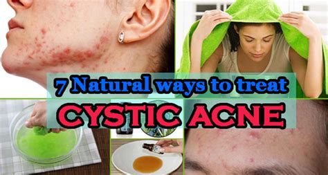 How To Get Rid Of Cystic Acne With These Simple Completely Natural