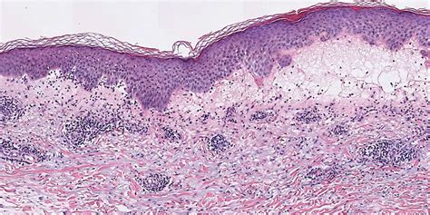 Tender Diffuse Edematous And Erythematous Papules On The Face Neck