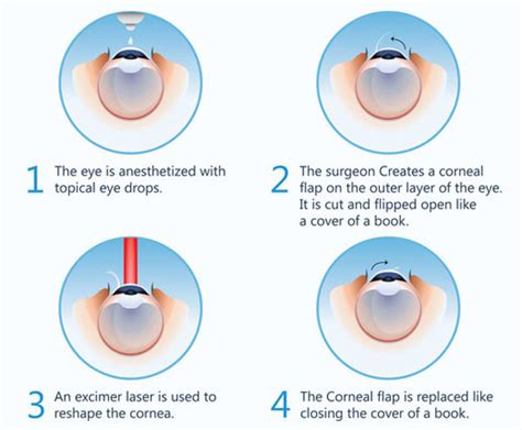 Refractive Lasik Laser Eye Surgery And Treatment In Bhubaneswar