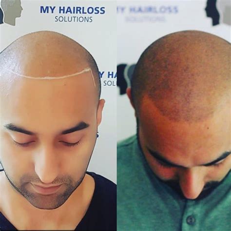 Scalp Micropigmentation For Men Advanced Smp In Manchester