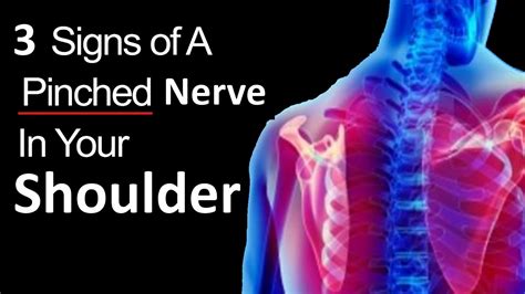 Pinched Nerve In Shoulder Symptoms Causes And Effective