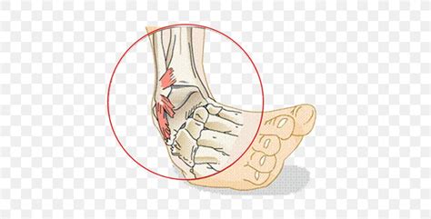 Sprained Ankle Ligament Injury Png 418x418px Watercolor Cartoon