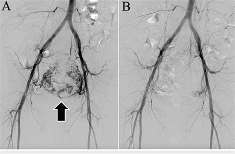 Angiographic Images Before And After Uterine Artery Embolization A