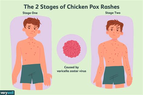 Chicken Pox Stages