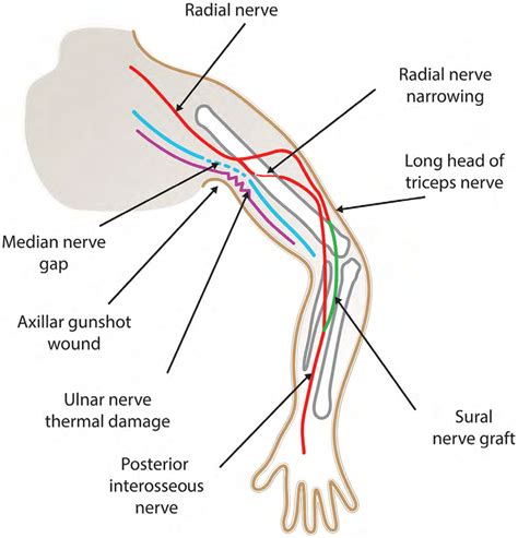 Schematic Of The Reconstructive Technique Of Nerve Transfer Of The Long