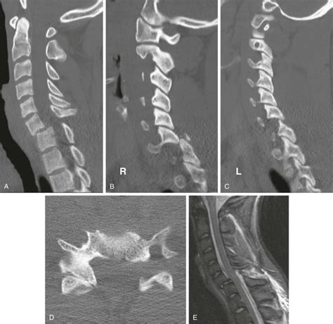 Subaxial Cervical Spine Trauma Musculoskeletal Key