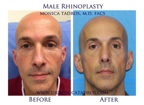 Colin male was born on august 8, 1925 in buffalo, new york, usa. Male Rhinoplasty Before & After - B - Dr. Monica Tadros ...