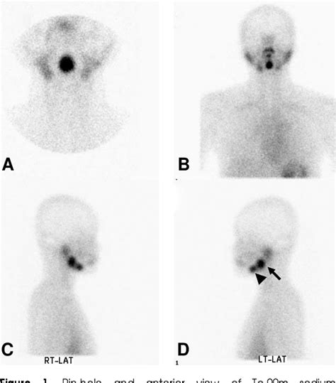 Figure 1 From Dual Lingual Thyroid Mimicking Mono Ectopic Thyroid In