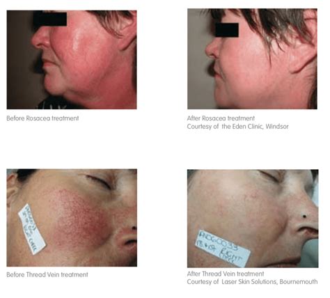 Laser Red Vein Removal For The Face At Cheshire Lasers Middlewich