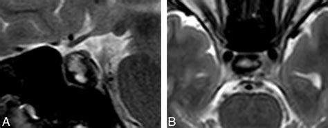 Differentiation Between Cystic Pituitary Adenomas And Rathke Cleft