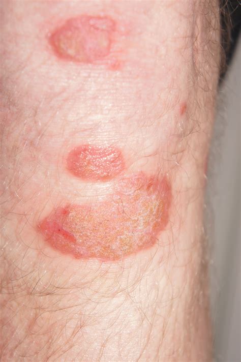 Dry Spots On Skin