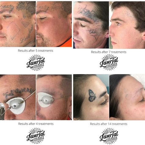 Top 100 Tattoo Removal Before And After Photos