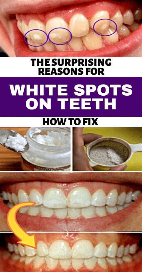 White Spots On Teeth Cause Lots Of Folks To Become More Selfconscious