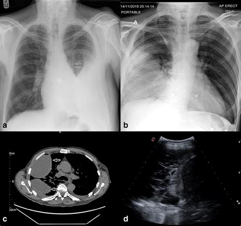 A Chest X Ray With Partially Encysted Left Sided Pleural Effusion With