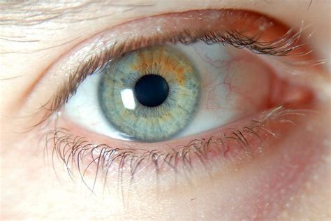 Sectoral Heterochromia By Icopythat Via Flickr Heterochromia Eyes