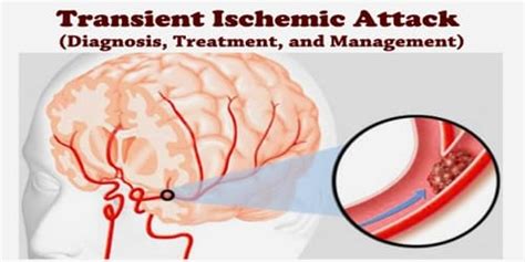 Transient Ischemic Attack Diagnosis Treatment And Management